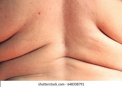 Asian Fat Women Has Overweight. She Shows Excess Fat Of The Back