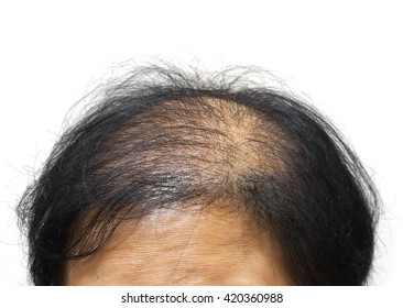 Asian Female Head With Hair Loss