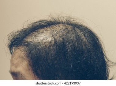 Asian Female Head With Hair Loss Problem In Vintage Tone