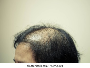 Asian Female Head With Hair Loss Problem In Vintage Tone