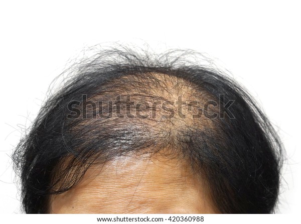 Asian Female Head Hair Loss Stock Photo Edit Now 420360988