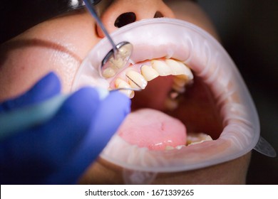 Asian Female Patient On Dentist Appointment During Dental Procedure. Human Mouth Open Close Up. Spot Light In A Face. The Doctor Examines The Gums With A Periodontal Measuring Probe. Real Process.