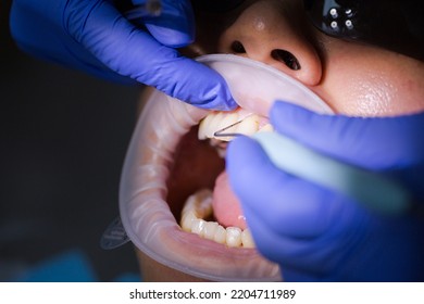 Asian Female Patient On Dentist Appointment During Dental Procedure. Human Mouth Open Close Up. Spot Light In A Face. The Doctor Examines The Gums With A Periodontal Measuring Probe. Real Process.