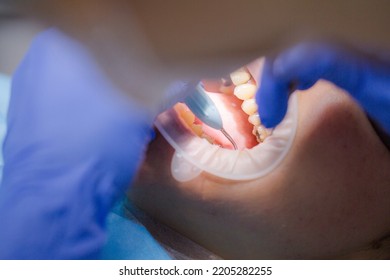 Asian Female Patient On Dentist Appointment During Dental Procedure. Human Mouth Open Close Up. Spot Light In A Face. The Doctor Examines The Gums With A Periodontal Measuring Probe. Real Process.