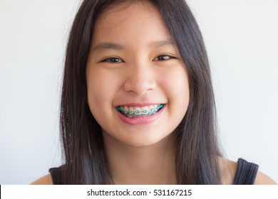 Asian Girl Has Braces ,asian Girl Is Smiling With Green Braces