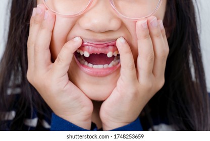 Asian Girl Laughing And Being Goofy Showing His Lost Teeth.