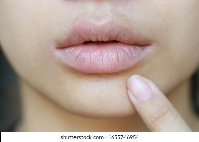 Asian Girl Points Her Forefinger To Her Dry Cracked Lips : Focused On The Upper Lip