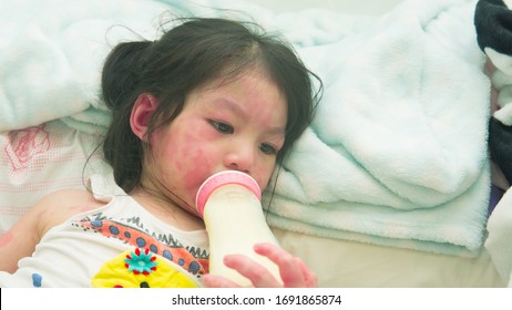 Asian Girl With Rash From Milk Allergy.