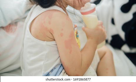 Asian Girl With Rash From Milk Allergy.