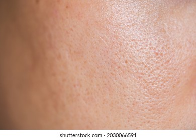 Asian Male Close Up Has Skin Problem, Large Pores