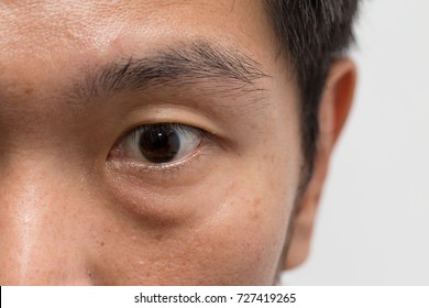 Asian Male Man Face Oily Skin With Big Eye Bag At The Left Eye