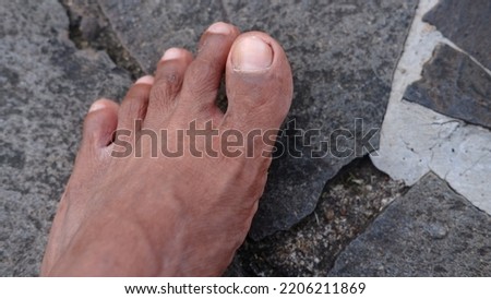 Asian male toes with dry skin