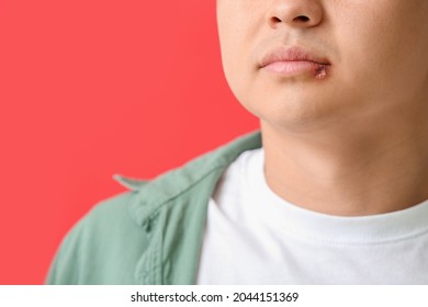 Asian Man With Cold Sore On Color Background