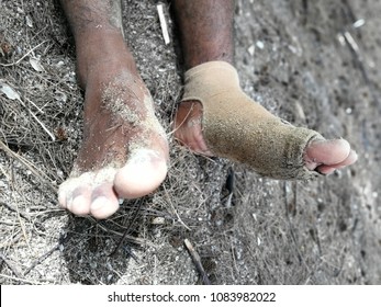 An Asian Man Had A Bandage On The Dirty Ankle