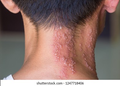 asian man has herpes zoster on his neck  - Shutterstock ID 1247718406