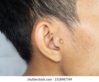 Mole On Ear Images Stock Photos Vectors Shutterstock