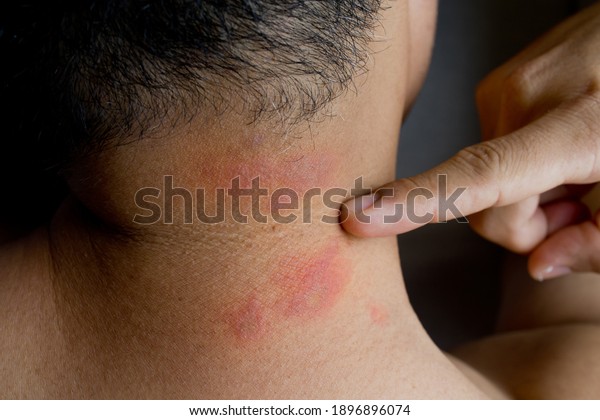 Asian man sitting with his back turned and\
scratching bitten, red, swollen neck skin from rove beetle also\
known as \