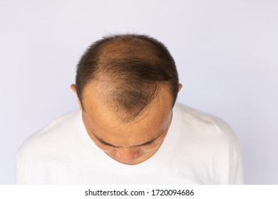 Asian Men Hair Loss Portrait On The White Background