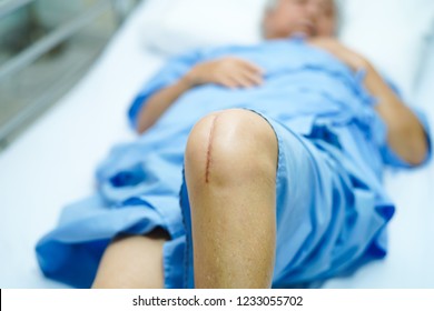 Asian senior or elderly old lady woman patient show her scars surgical total knee joint replacement Suture wound surgery arthroplasty on bed in nursing hospital ward : healthy strong medical concept.
