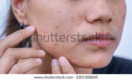 An Asian teenage girl with uneven facial skin problems. The invasion of acne, inflamed acne, clogged acne, pustules, chronic acne problems Redness on cheeks. Sensitive skin. Skin care concept.