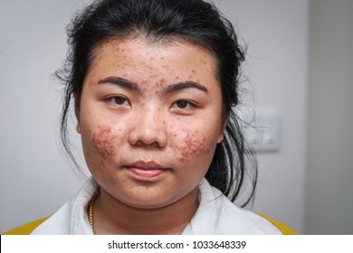 Asian Woman With Acne On Face.