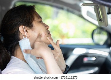 Asian woman with acne on the face caused by wearing face mask,accumulation of fungi,bacteria from sweat,skin irritation,inflammation,girl is allergic to mask causing acne vulgaris problem,skin care - Powered by Shutterstock