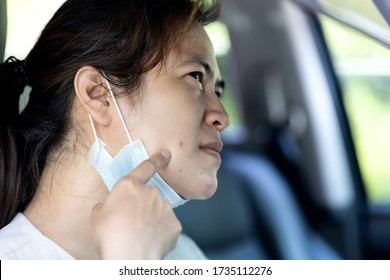 Asian Woman With Acne On The Face Caused By Wear A Face Mask During The Outbreak Of Covid-19 Coronavirus,skin Irritation From Sweat,female Is Allergic To Mask Causing Acne Vulgaris Problem,skin Care