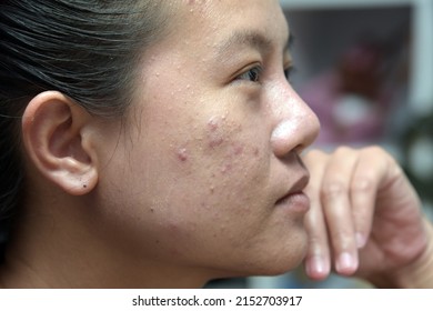 Asian Woman Is Annoyed And Bored With Hormonal Acne But She Still Smiles. Skin Problems And Acne Scar, Before And After Acne Facial Care Treatment, Beauty Concept.