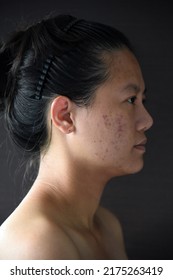 Asian Woman Is Annoyed And Bored With Hormonal Acne But She Still Smiles. Skin Problems And Acne Scar, Before And After Acne Facial Care Treatment, Beauty Concept.