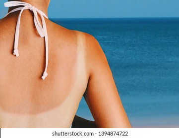 Asian woman back with red skin sunburn after sunbathing on the beach.