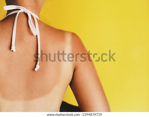 Asian woman back with red skin sunburn after\
sunbathing on the beach.