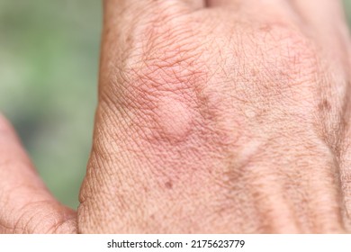 Asian Woman Back Of Right Hand With Red Swelling From Hornet Sting On Skin Background
