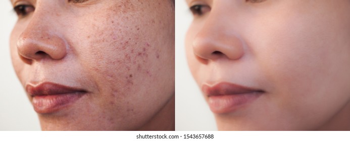 Asian woman before and after dark spot melasma pigmentation  skin treatment on face. Problem skincare and beauty concept. 