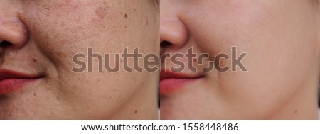 Asian woman face before and after dark spot melasma facial treatment. Problem skincare skincare and health concept. 