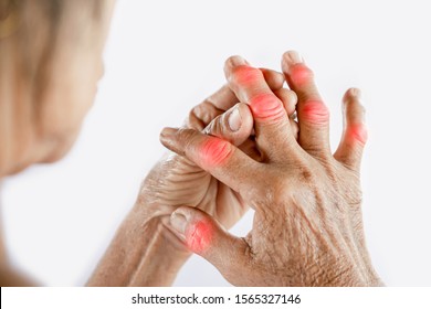 Asiatische Frau, die Gelenkschmerzen mit Gicht im Finger leidet