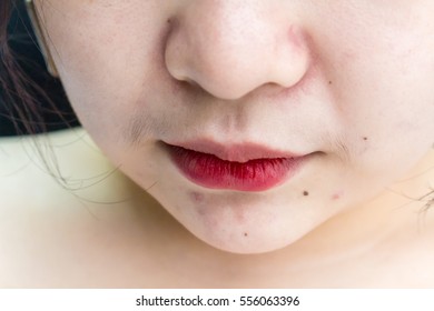 asian woman has mole, mustache pimple and