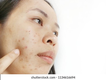 Asian Woman Have Scars And Dark Spots.The Use Of Chemicals From Cosmetics.Make Up I Used To Stop Acne On The Face,black Spots Are Very Harmful To Health.In The White Background.