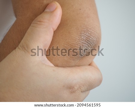 Asian woman having problem with dry, damage and dark skin on elbow. closeup photo, blurred.
