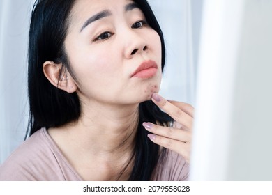 Asian woman having skin face problem with acne and scars on chin