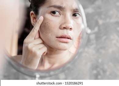 Asian Woman Having Skin Problem Checking Her Face With Dark Spot, Freckle From Uv Light In Mirror