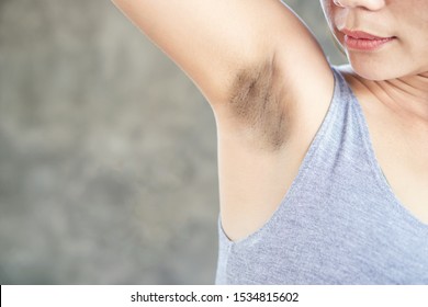 Asian woman having skin problem with black armpits 