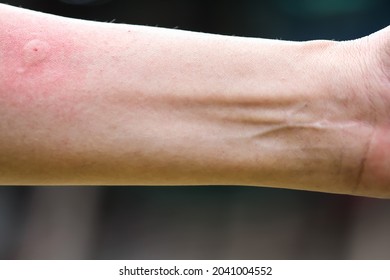 Asian Woman Left Arm With Red Swelling From Hornet Sting On Skin Background