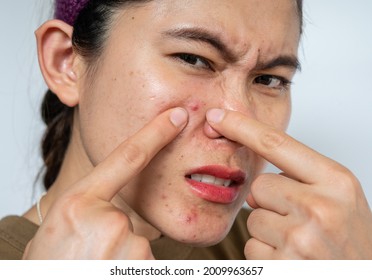 Asian woman pointing to acne inflamed on her face. Inflamed acne consists of swelling, redness, and pores that are deeply clogged with bacteria, oil, and dead skin cells.