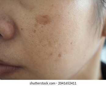 Asian woman problem skin with blemish and spots. closeup photo, blurred.