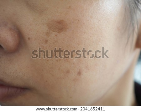 Asian woman problem skin with blemish and spots. closeup photo, blurred.