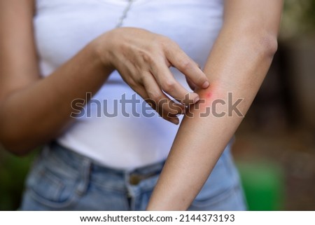 Asian woman scratching her arm skin, health care concept image of mosquito bite, allergic dermis inflammation, fungus infection, dermatology disease, malaria, dengue, tropical mosquito virus infection