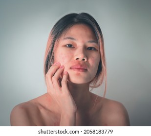 Asian Woman Scratching On Skin Allergy On Her Face From Cosmetic And Make Up Making Her Skin All Over The Body Red Itchy And Painful.