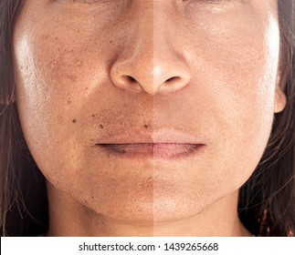 Asian Woman With Spotty Skin With Deep Pores And Blackhead And Healed Soft Skin. Com Pair From Before And After Skin Treatment. 