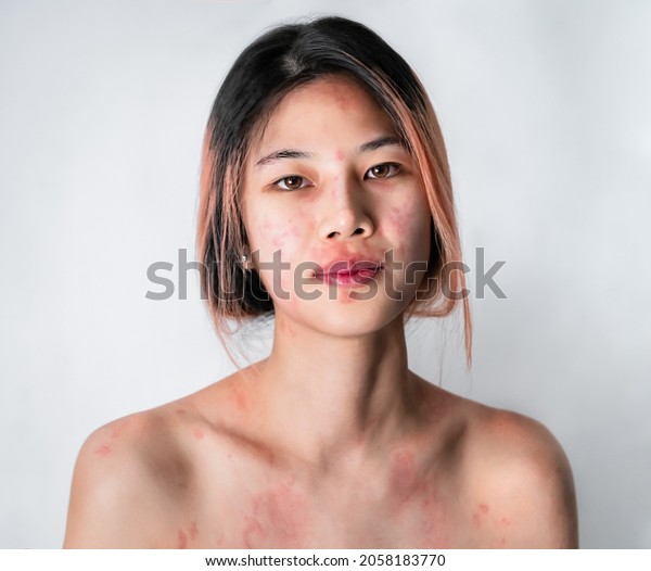 Asian\
woman suffering from Skin allergy from Cosmetic and Make up making\
her skin all over the body red itchy and\
painful.