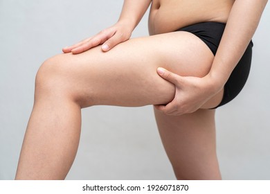 Asian woman is testing the skin for stretch marks and cellulite or showing her cellulite. ,Cellulite skin on her legs. Surgery or health care, beauty and female concept